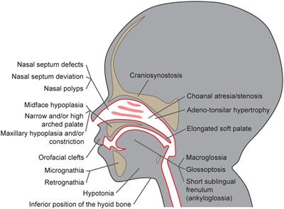 Candidate genes for obstructive sleep apnea in non-syndromic children with craniofacial dysmorphisms – a narrative review